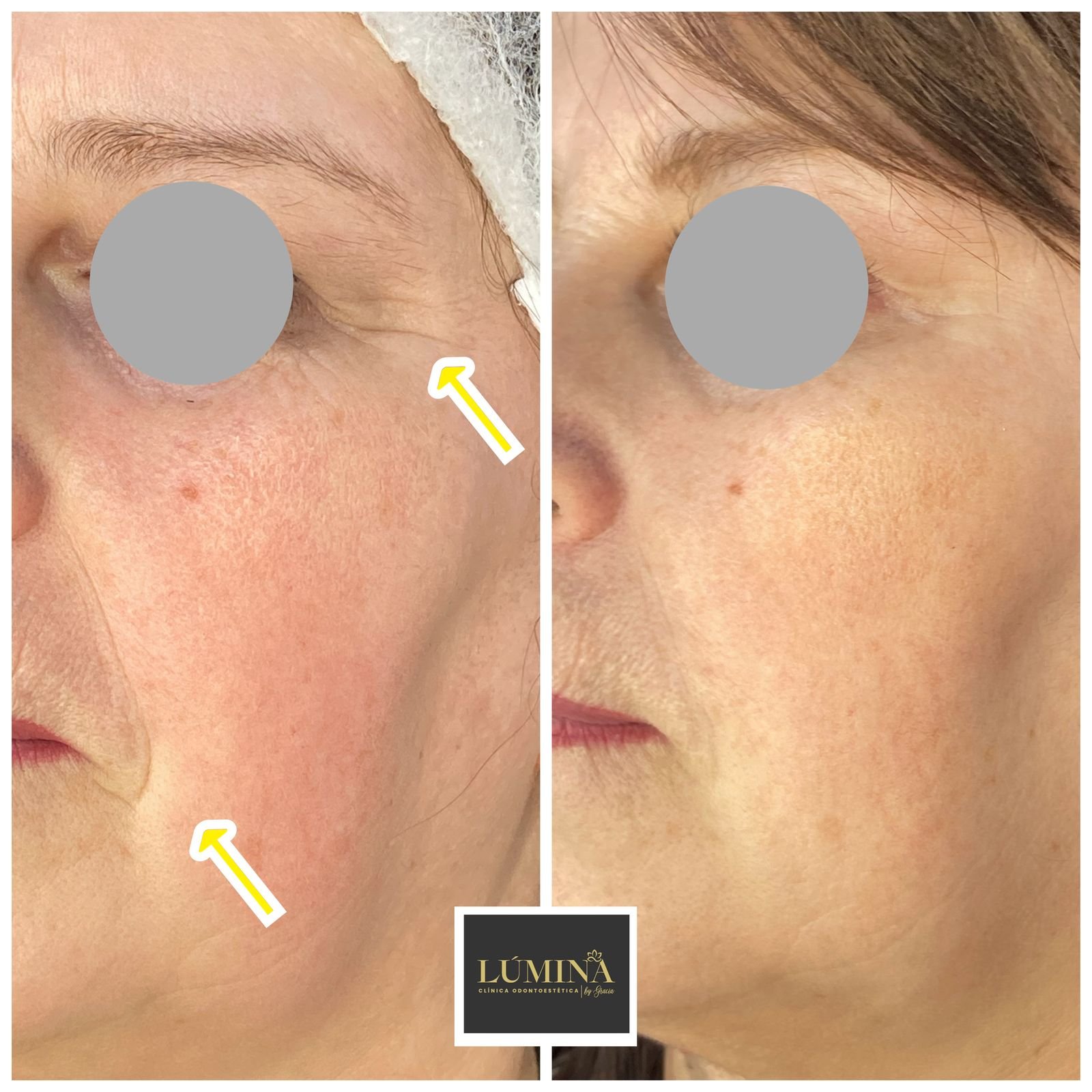 Viscoderm