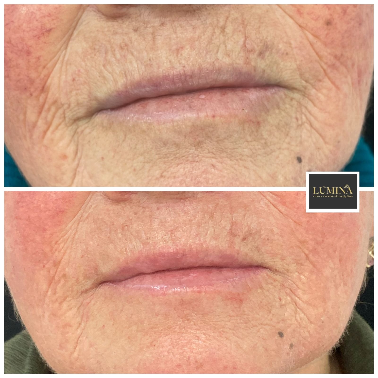 Viscoderm 2